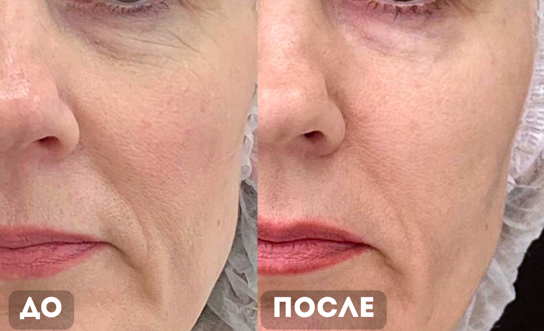 Морфеус: до и через 1 год после